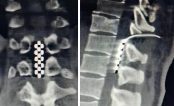 脊髓电刺激术：以科技和时间之力，助脊髓损伤患者重获功能希望