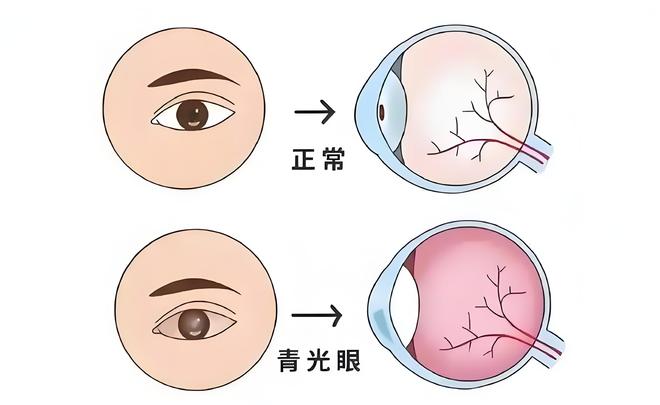 青光眼：警惕 “无声的视力小偷”，深圳普瑞助力科学守护眼健康