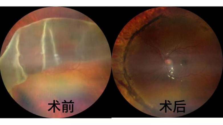 视网膜突然脱离？顺德爱尔眼科医院24小时内紧急手术复位视网膜