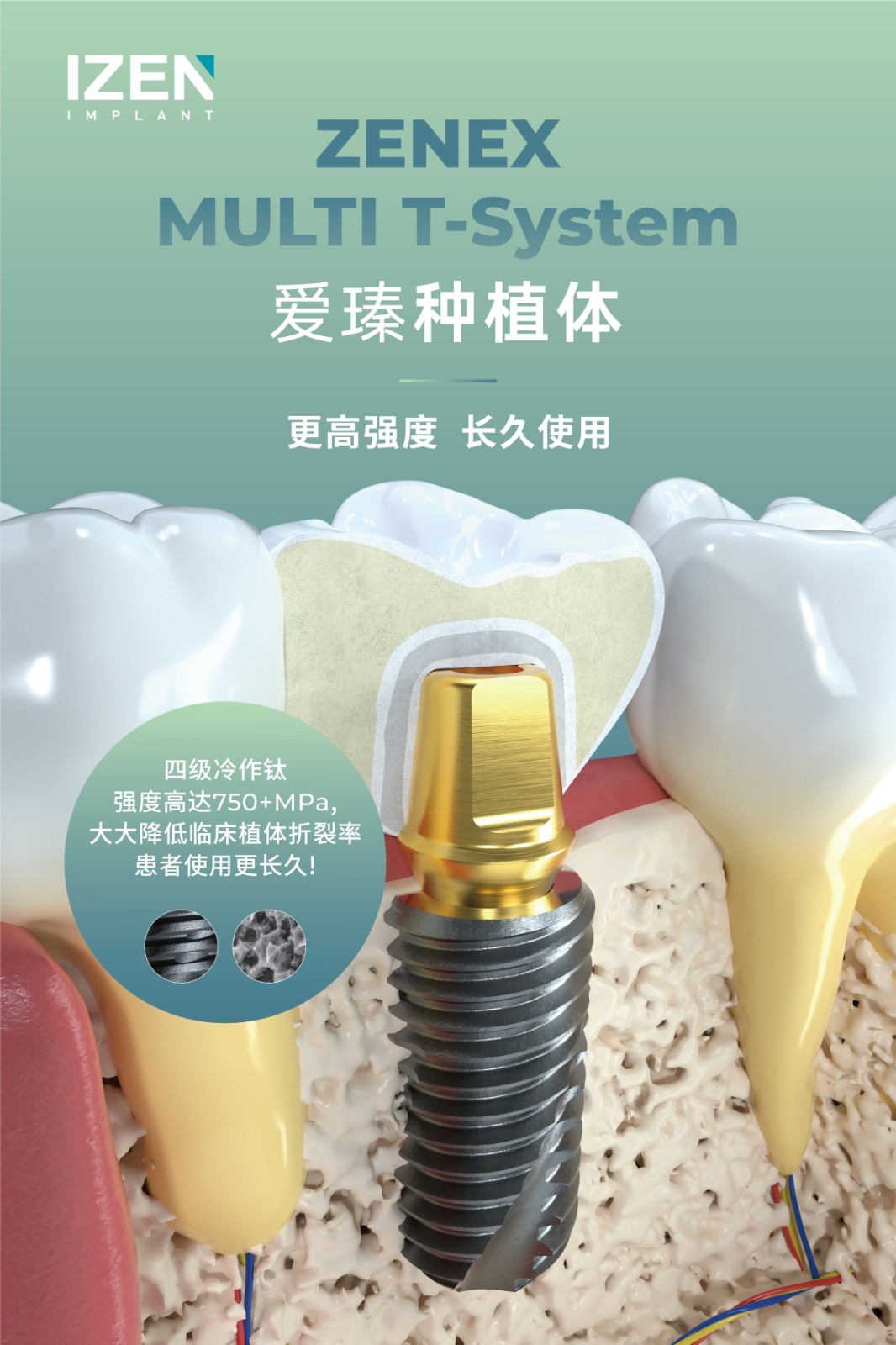 爱瑧IZEN（又名：爱臻）种植体荣登韩国中小企业研发卓越奖50强榜单，彰显强劲创新实力