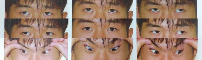 南昌爱尔杨秋艳主任主刀，16岁先天外斜视患者“视”界归正