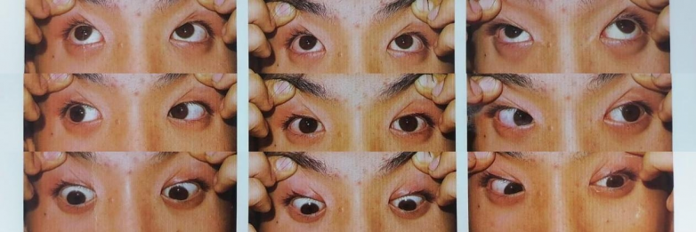 南昌爱尔特邀余新平教授开展手术，成功矫正17岁少年间歇性外斜视