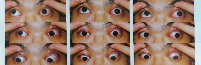 南昌爱尔特邀权威专家余新平，成功为知觉性外斜视患者矫正眼位