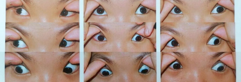 12岁少年摆脱共同性外斜视！南昌爱尔杨秋艳助其重获清晰视功能